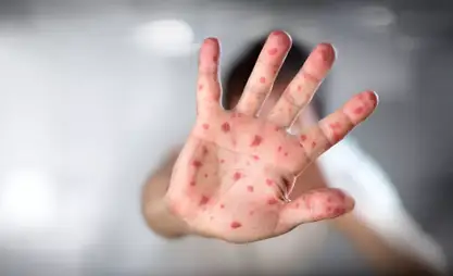 Ситуация с корью в стране остаётся напряжённой