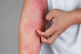 allergiya-na-rybu-simptomy-foto-1024x682