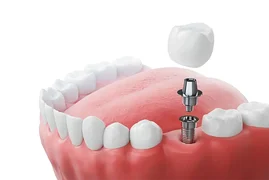 dental_implant.webp