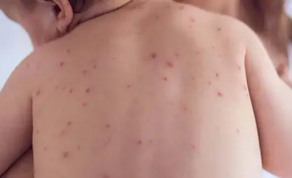 Депутат Жогорку Кенеша: В Кыргызстане ситуация с корью остается острой